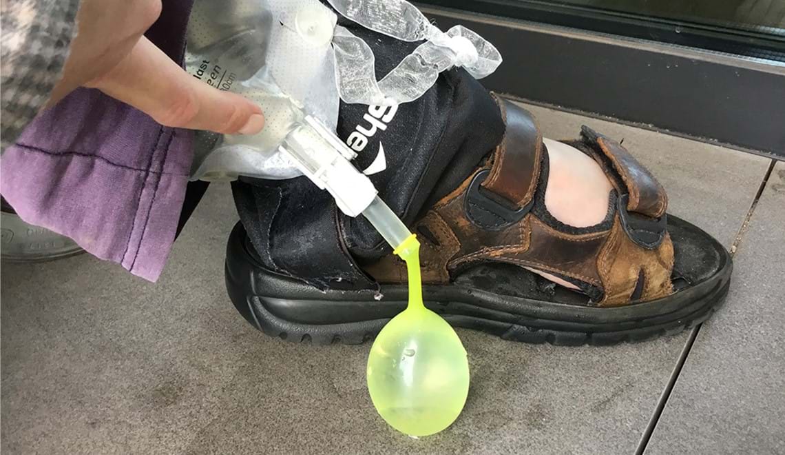 A photo of a foot wearing a brown sandal with a yellow balloon-like object coming out of a clear medical bag next to it.